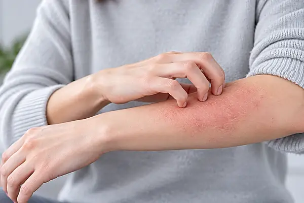 Close-up of an irritated forearm with eczema or dermatitis being scratched